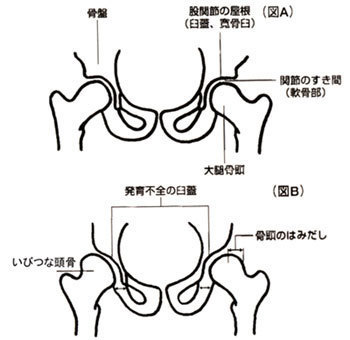 熊本 股関節症 股関節痛 熊本館はざま整体院 施術歴38年 体験談等150件必見 変形性股関節症 臼蓋形成不全